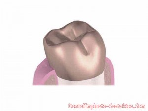 dental-crowns-in-costa-rica