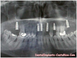 mini-implants-in-costa-rica