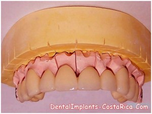 Full Arch Implant Bridge in Costa Rica 