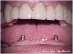 snap-on-dentures-in-costa-rica_0