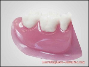 dental-plates-in-costa-rica