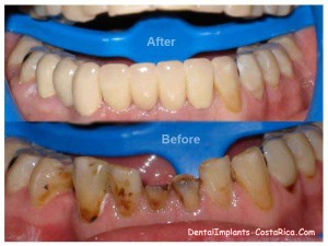 Aesthetic dentistry - before and after