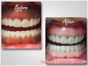 Gum depigmentation in Costa Rica