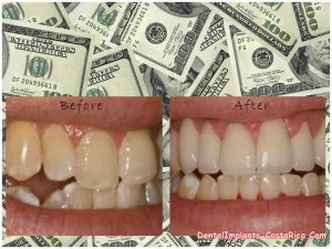 Cost of dental veneers in Costa Rica
