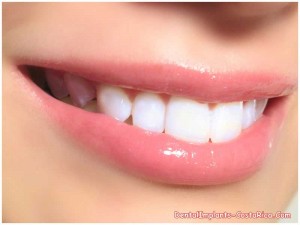 Denta Bleaching in Costa Rica