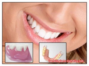 Partial dental plates
