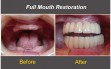 Full Mouth Restoration - Before and After Dental Treatment
