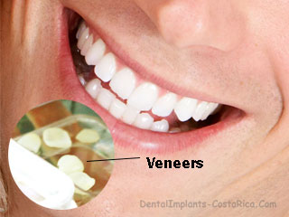 Dental Veneers in San Jose - Costa Rica